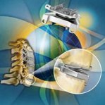 Prestige LP cervical disc system